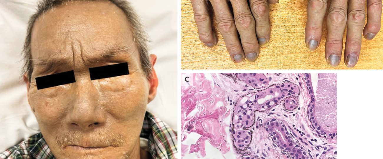 Mysterious silver poisoning turned an 84-year-old gray for good