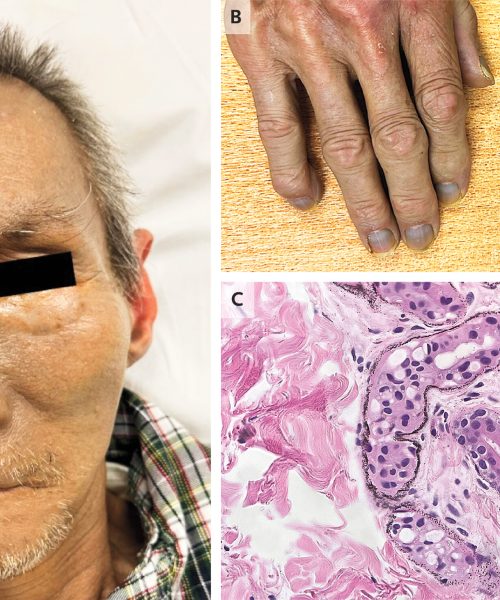 Mysterious silver poisoning turned an 84-year-old gray for good