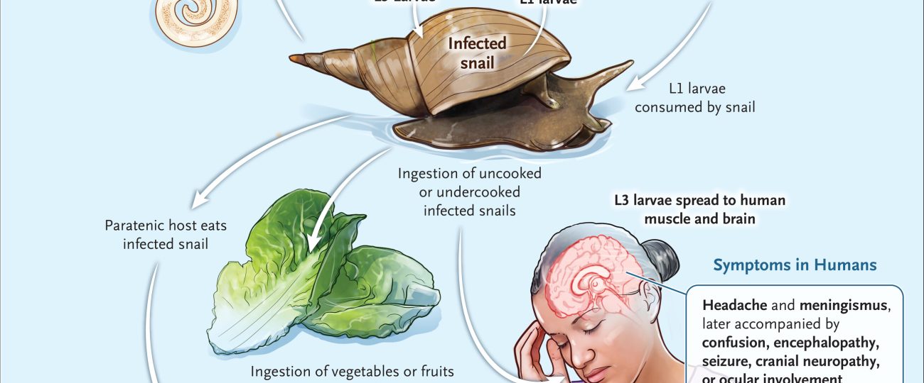 Patient’s tingling feet turns out to be a rat-borne brain parasite
