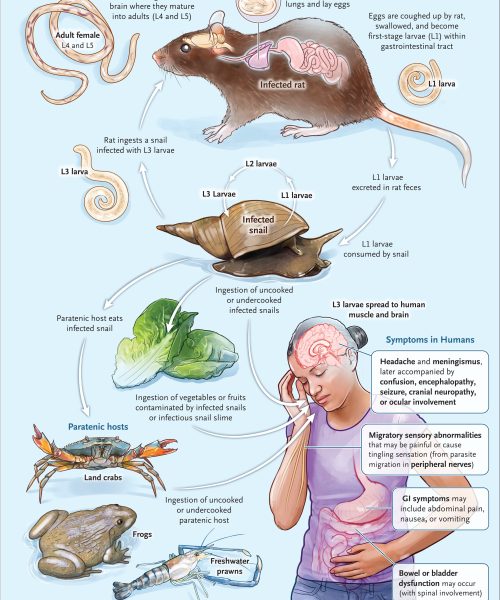 Patient’s tingling feet turns out to be a rat-borne brain parasite