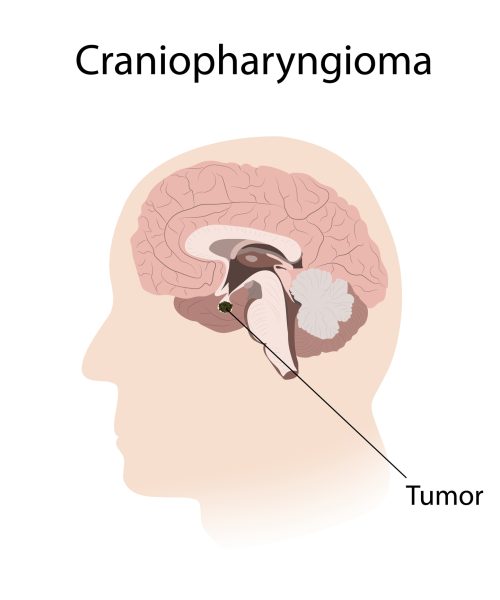How an unusual medical procedure transmitted Alzheimer’s