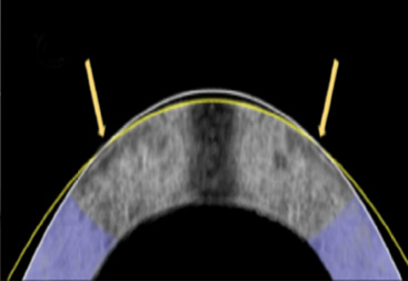 The electromechanical reshaping technique successfully flattened this rabbit cornea, shown in a cross section, from its original shape (white line) to a corrected one (yellow line). 