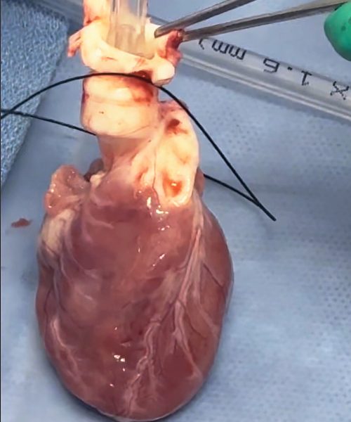 Surgeons develop 2 ways to ‘restart’ hearts without a donor’s body