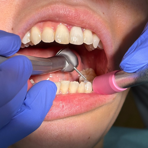 Quieter dental drills may be on the horizon