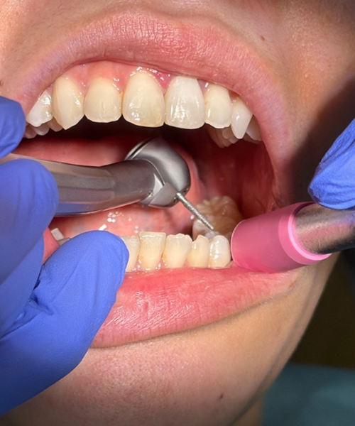 Quieter dental drills may be on the horizon