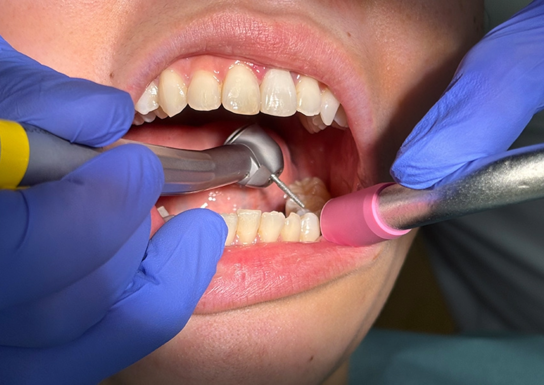 A dental drill being used in a patient’s mouth. 
